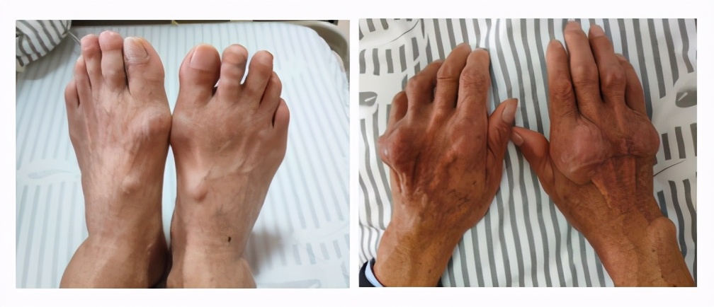 痛风超微创针刀,中医微创针刀镜治疗痛风