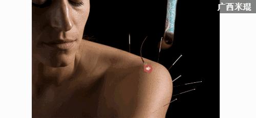 骨科大夫米琨为您详解:关节痛了怎么办?