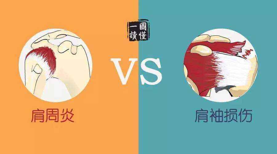 肩袖损伤不完全撕裂严重不严重,肩袖损伤不治疗得好吗