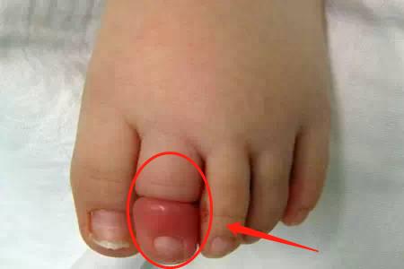 两岁宝宝腿上被虫子咬了肿很大,小孩脚后跟被蜱虫咬