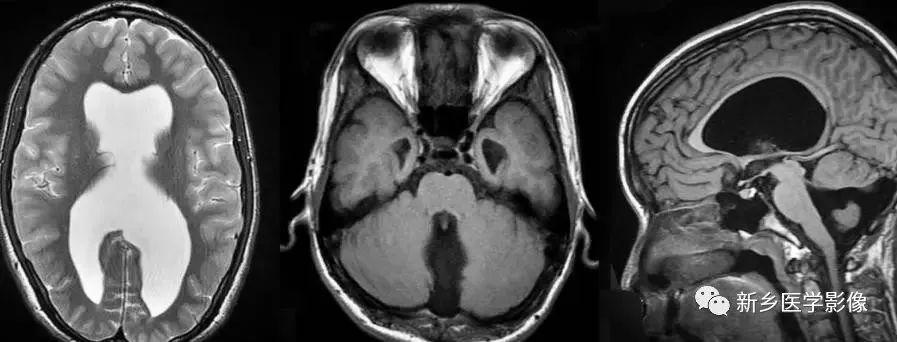 什么引起成人脑室扩大,哪些病可以导致左侧脑室增宽