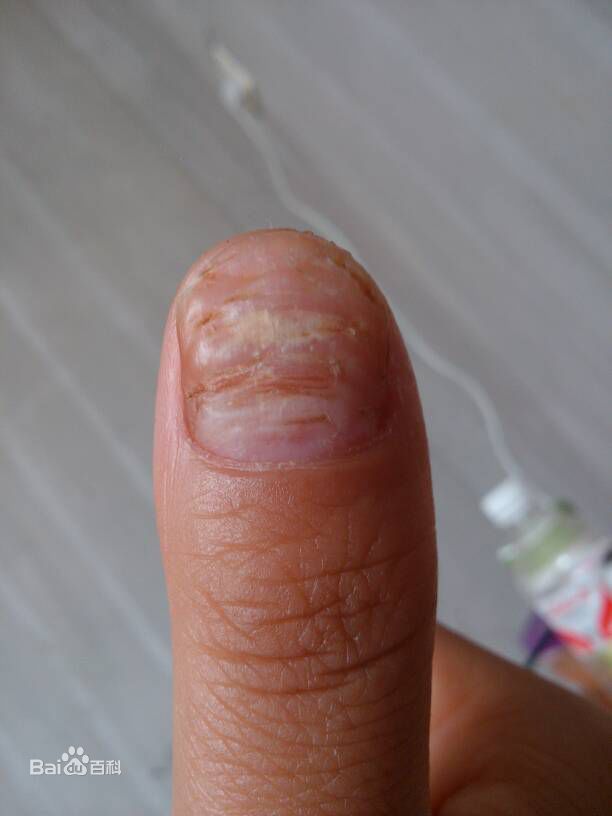 系统性红斑狼疮雷诺综合征,红斑狼疮雷诺综合征怎么治疗