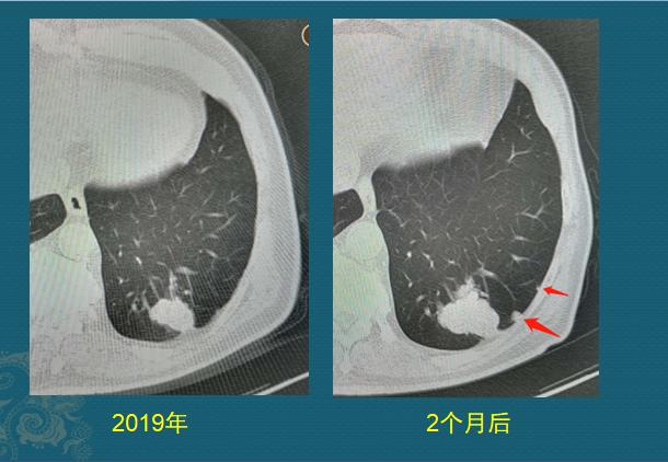 新冠肺部感染应对,新冠肺癌抗癌