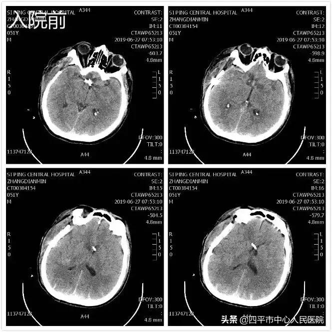 精准排雷再现新高—神经外科在6月份成功救治6例颅内动脉瘤患者