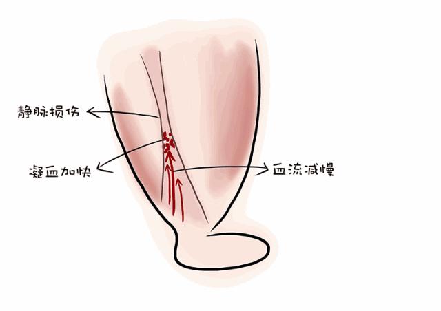 沉迷翘二郎腿的你，骨盆还好吗？
