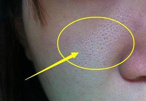 毛孔粗大肤质差如何去收缩毛孔,遮毛孔粗大收缩毛孔最有效的方法