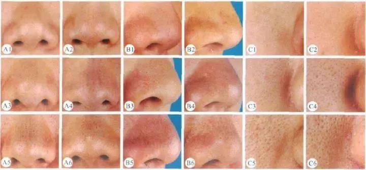 毛孔大到能插秧收敛只需这三步,毛孔粗到可以插秧该怎么自救