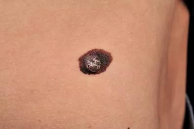 痣用点么,痣能点么