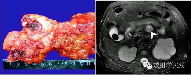 胰腺尾部肿块怎么判断,胰腺精准治疗