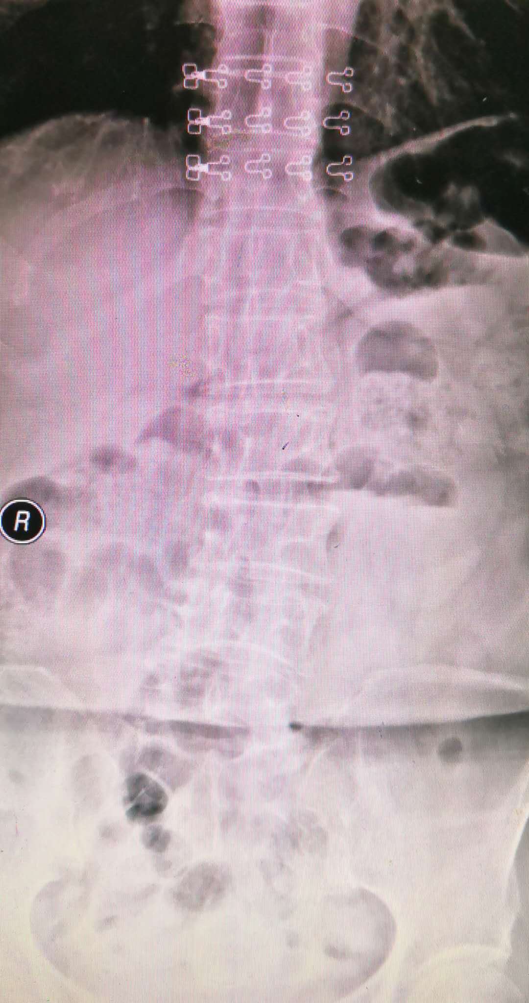 腰椎滑脱最终都要做手术么,为什么腰椎滑脱不建议手术