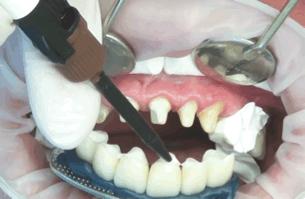 烤瓷牙贴片全口价格,贴片牙齿和烤瓷牙有哪些伤害