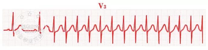 儿童阵发性室上心动过速,儿童阵发性室上性心动过速