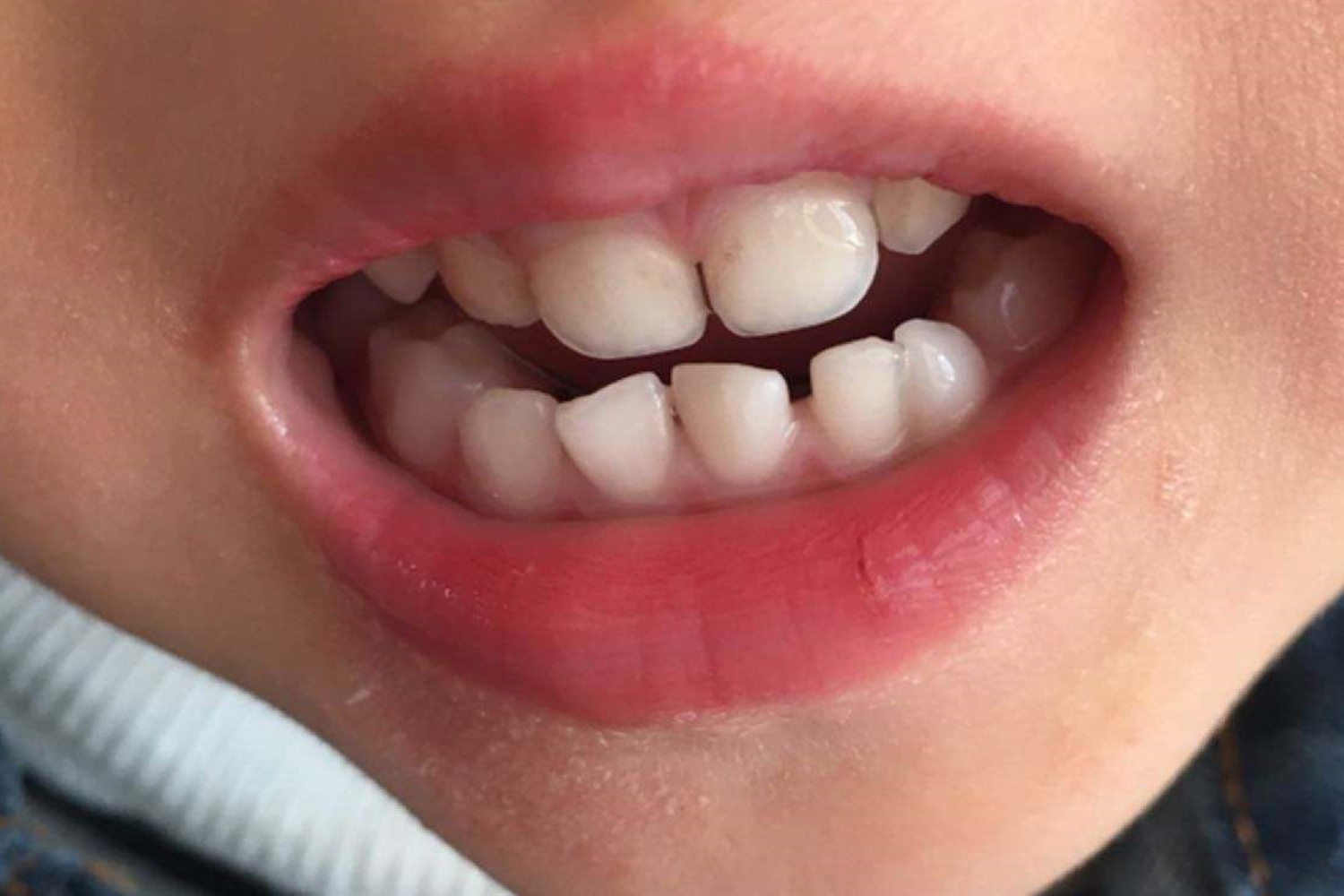 孩子经常嘴里有臭味怎么回事,小孩不爱刷牙嘴巴臭正常吗