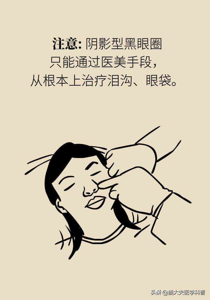 医生黑眼圈,手术消除黑眼圈靠谱吗