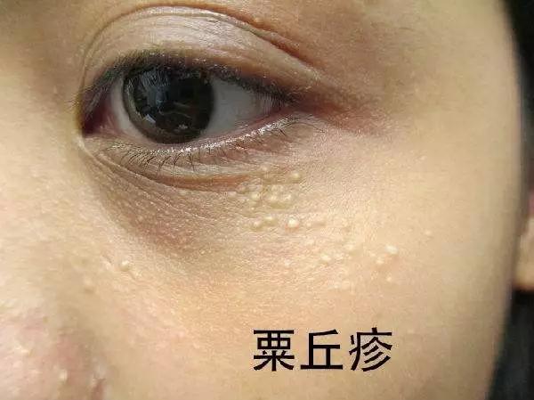 眼周脂肪粒可以激光去除吗,眼周脂肪粒会自动消失吗