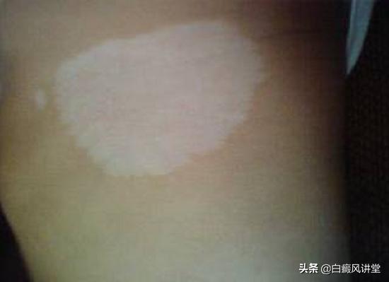 308准分子激光治白癜风几次见效,308nm准分子治疗白癜风的价格