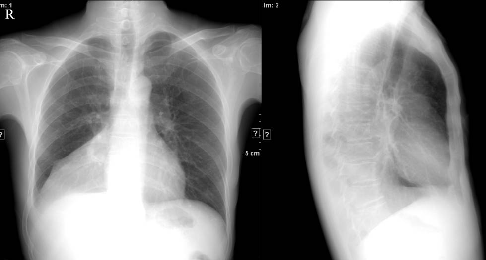 x线诊断边界模糊,x线诊断有误区吗