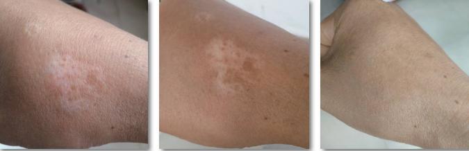 白癜风拉锯战最后结局,白癜风开始治愈图