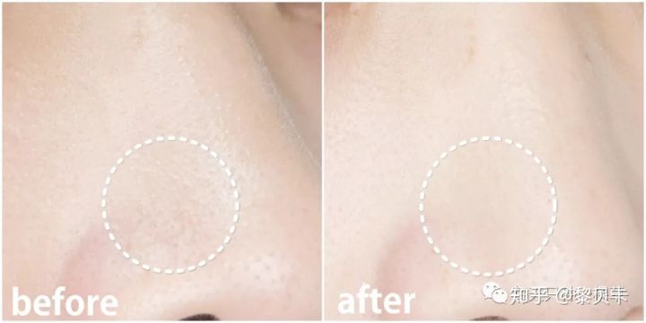 公认最好用的去黑头神器,网红推荐去黑头神器