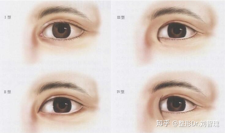 割双眼皮真的有必要吗,有必要割双眼皮吗