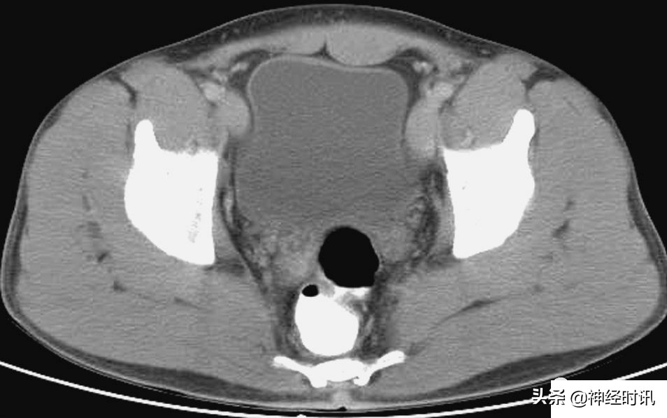 肾脏输尿管膀胱前列腺结构,肾输尿管膀胱解剖示意图