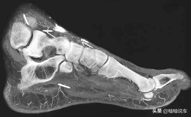 小孩被车压到脚上有什么后遗症,汽车车轮从脚上压过去会怎么样