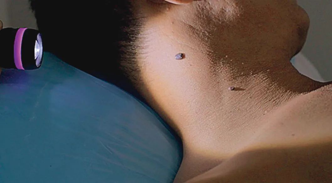 颈内静脉穿刺术禁忌,颈内静脉穿刺术教学视频