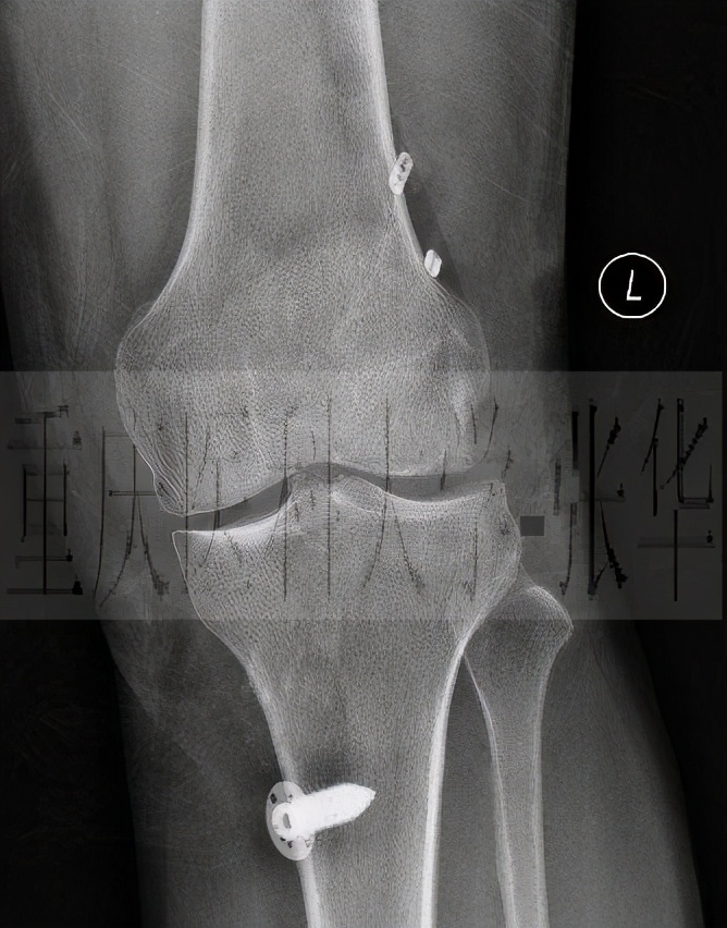 前交叉韧带损伤核磁共振,前后交叉韧带损伤的治疗