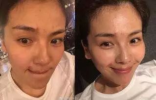 挤痘进了ICU，连下两次病危通知？这痘痘到底还能不能挤！