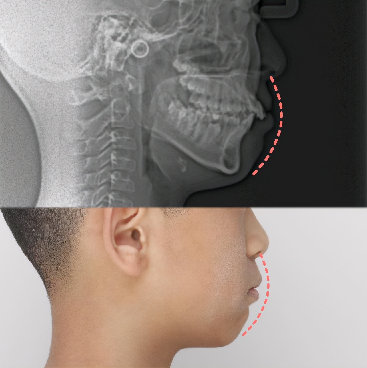 下颌后缩、咬合不对位，能用隐适美矫正吗？曹甜博士视频讲解案例