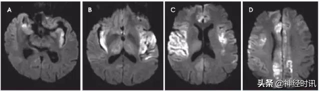 脑卒中病历诊断书图片,脑卒中影像判断技巧图解电子版