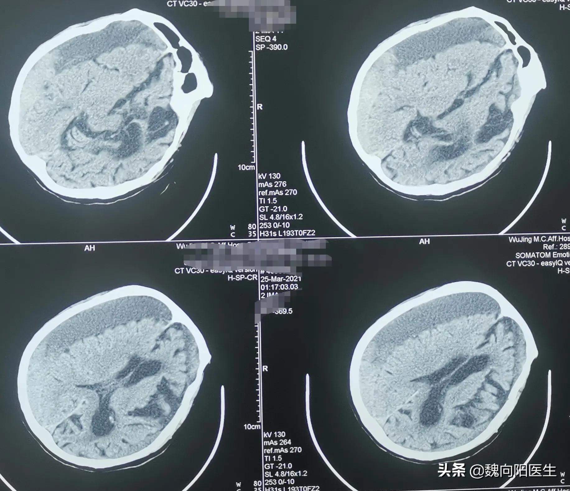 老年痴呆引起双腿无力怎么治疗,老年痴呆伴有精神症状还能治疗吗