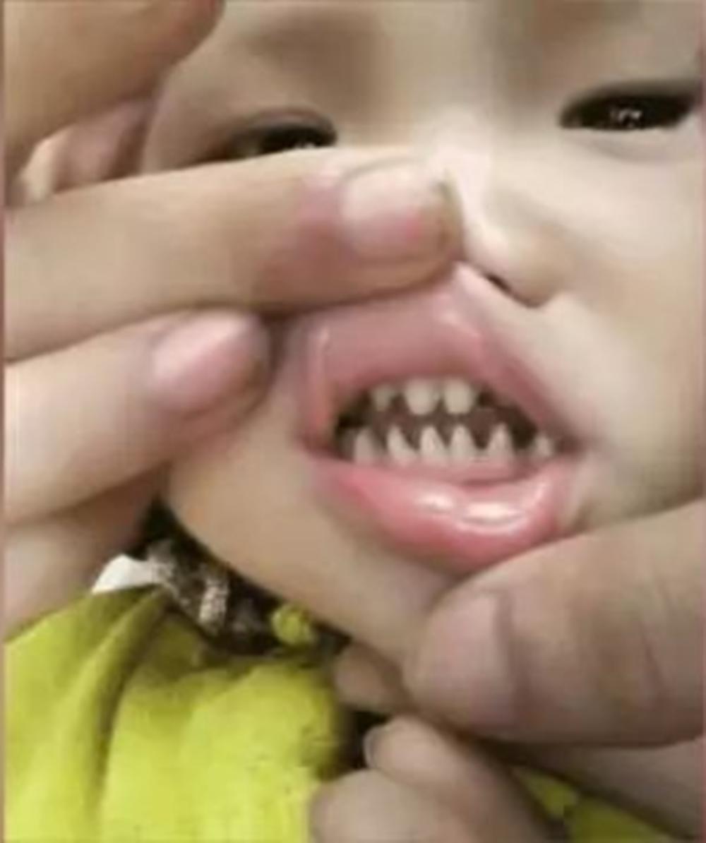小孩长了鲨鱼牙怎么办,孩子长鲨鱼牙齿的原因