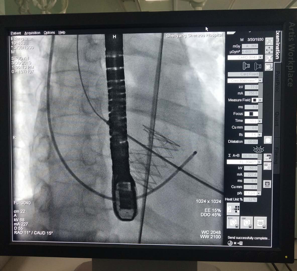 心脏病冠心病心血管疾病,冠心病心脏瓣膜病算是大病吗