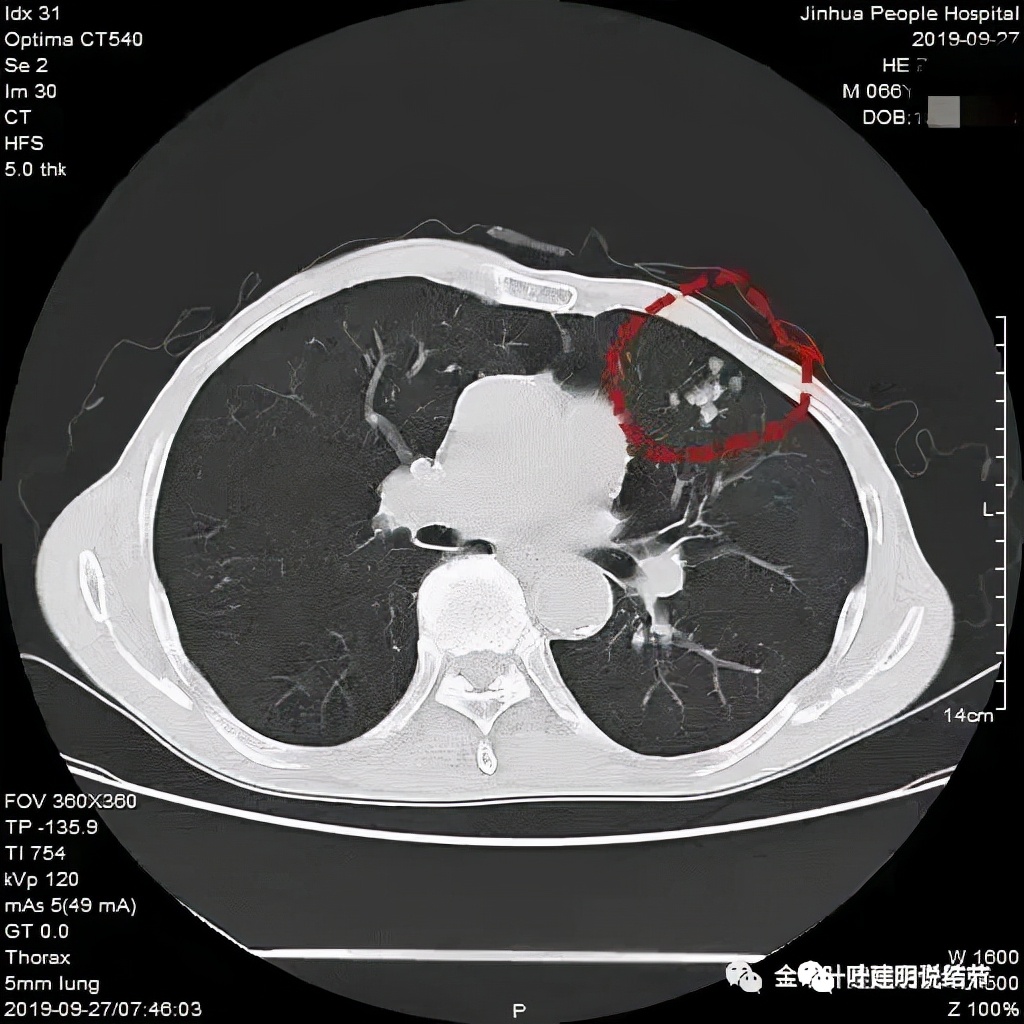 肺上有实性结节6mmx5mm是什么原因,肺上有1.7x1.8的实性结节该怎么办