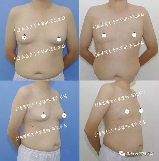 男性胸发育了怎么办,男性胸部发育了怎么办