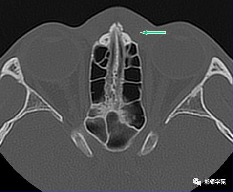 鼻骨骨折的检查方法,鼻骨骨折影像学表现
