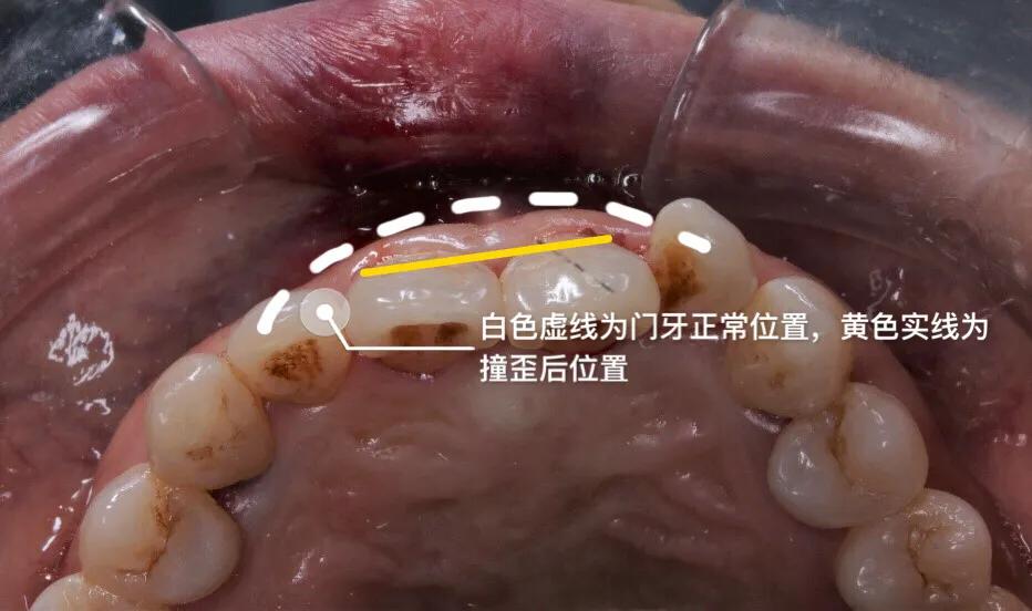 小明的牙齿被撞歪?1:1还原治疗过程,不让意外伤害一颗好牙