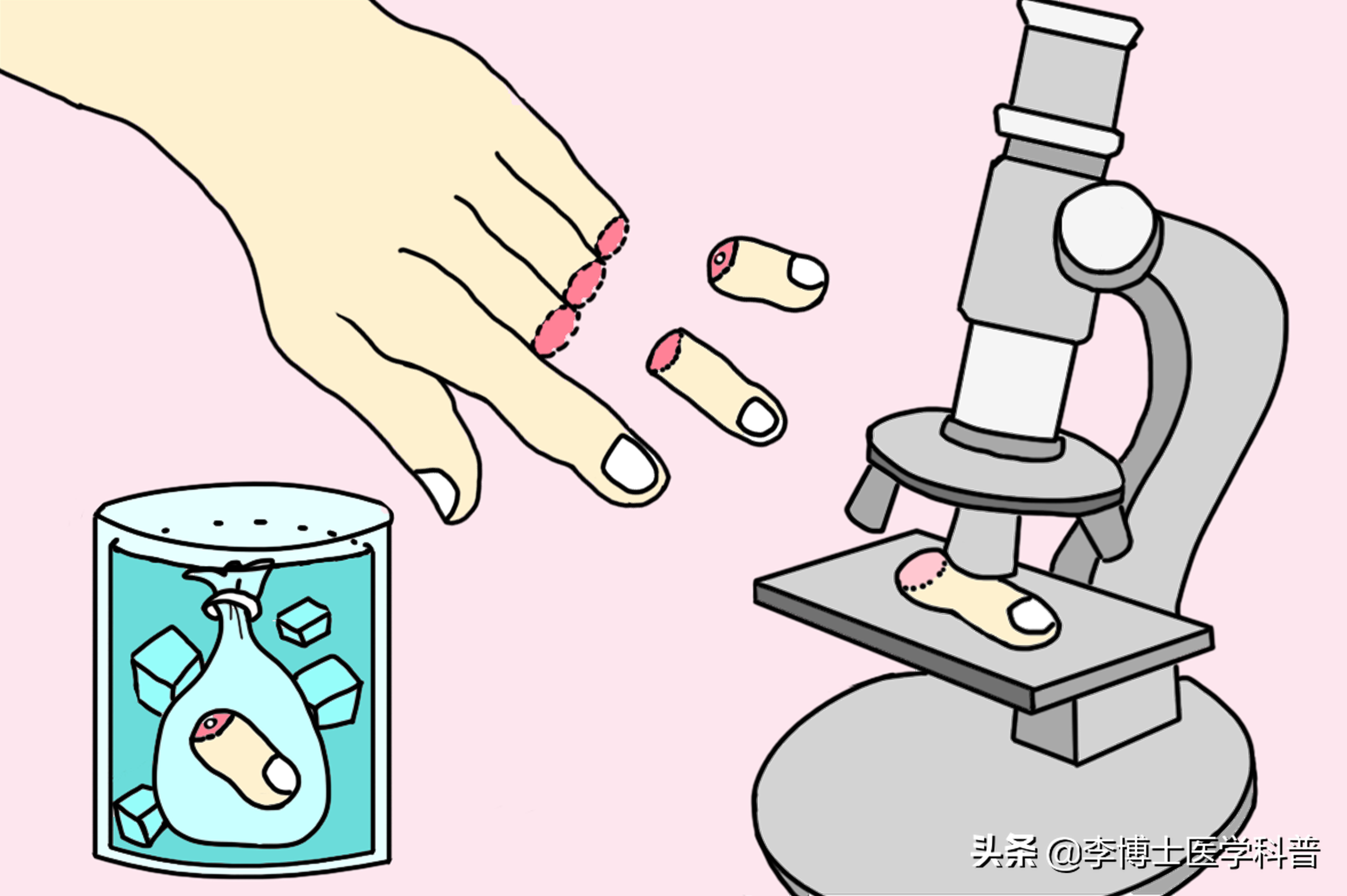 断指再植健康科普视频,断指再植技术是什么