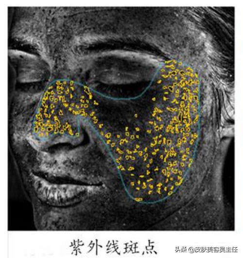 visia皮肤检测分高低吗,visia皮肤检测值多少是正常的