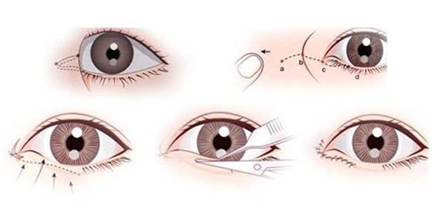 开了眼角会变回原来吗,开过的外眼角会长起来吗