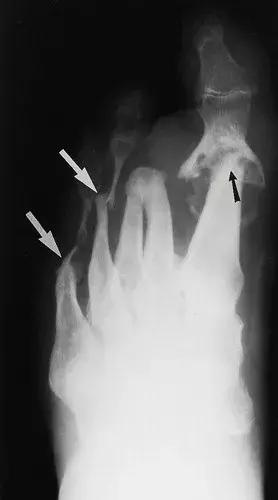 神经性骨关节病,神经性关节炎症状图片