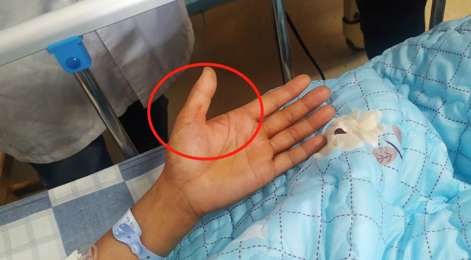 广西南宁一女子砍猪骨后发烧40度,砍猪骨头的刀砍到手会得破伤风吗