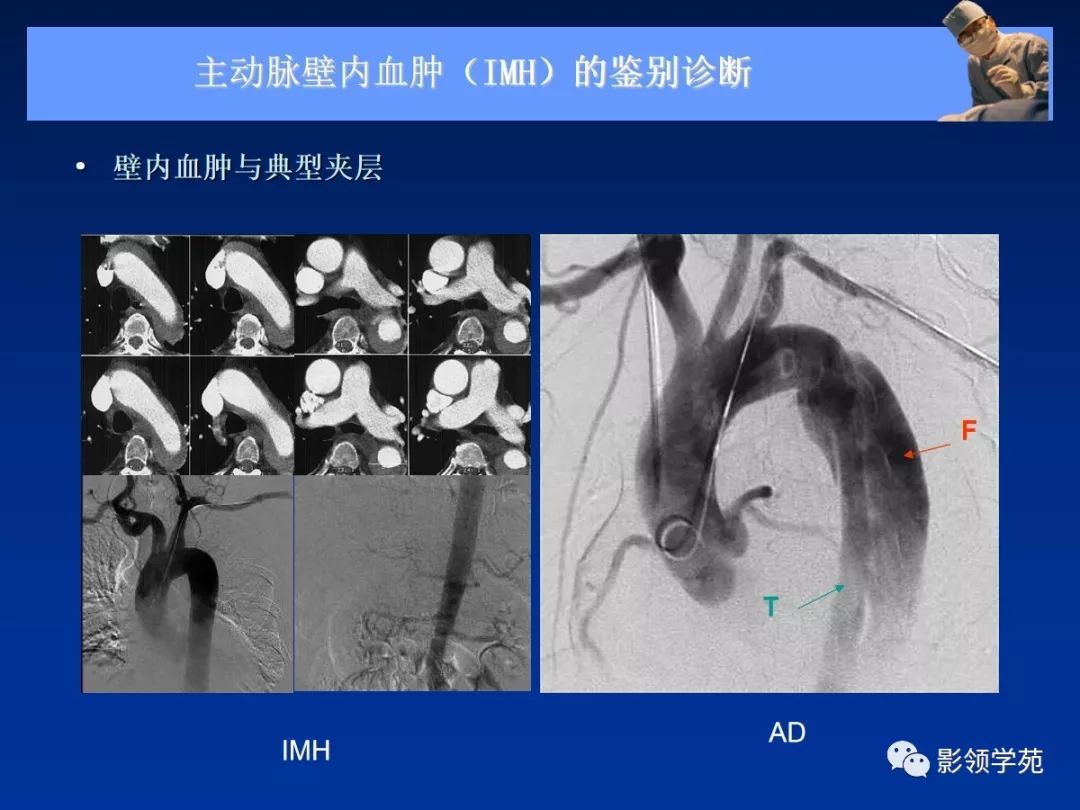 主动脉夹层壁间血肿如何鉴别,主动脉夹层血肿溃疡
