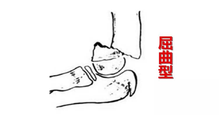 胳膊骨折三个月腿又骨折,孩子胳膊骨折好后还容易骨折么