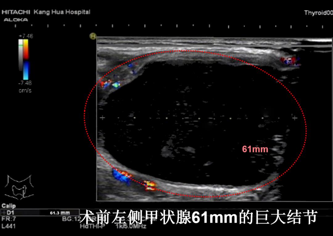 哈尔滨微创消融甲状腺结节哪家好,甲状腺结节微创消融术的过程