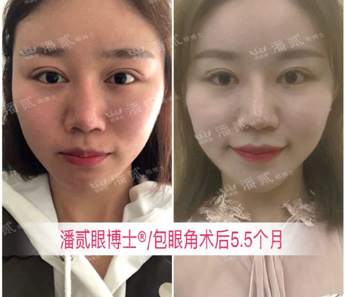 开眼角过大图片,开眼角过大修复效果图