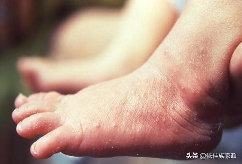 冬季晒太阳宝宝会加重湿疹吗,冬季洗澡太勤易患干燥性湿疹