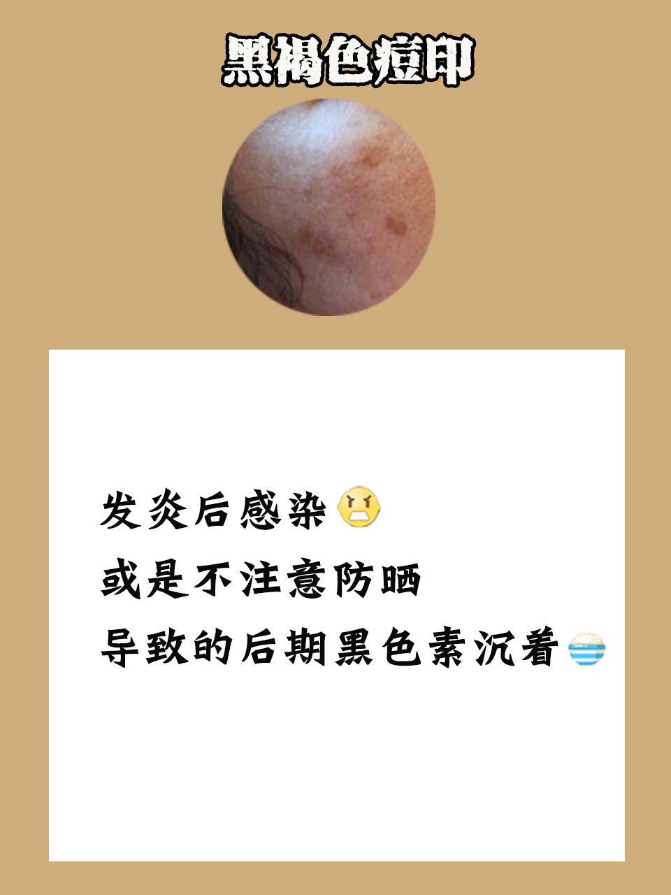 一夜祛痘印方法,祛痘印方法一周见效