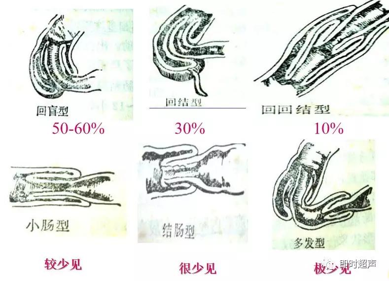 小儿消化道急症超声